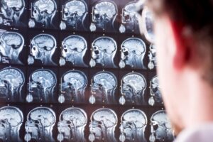 Doctor viewing MRI scan of head and brain