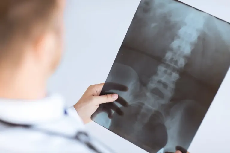 Close-up of doctor viewing spinal x-ray